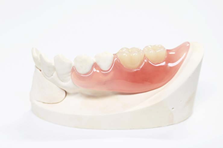 保険診療と自由診療の入れ歯の違い